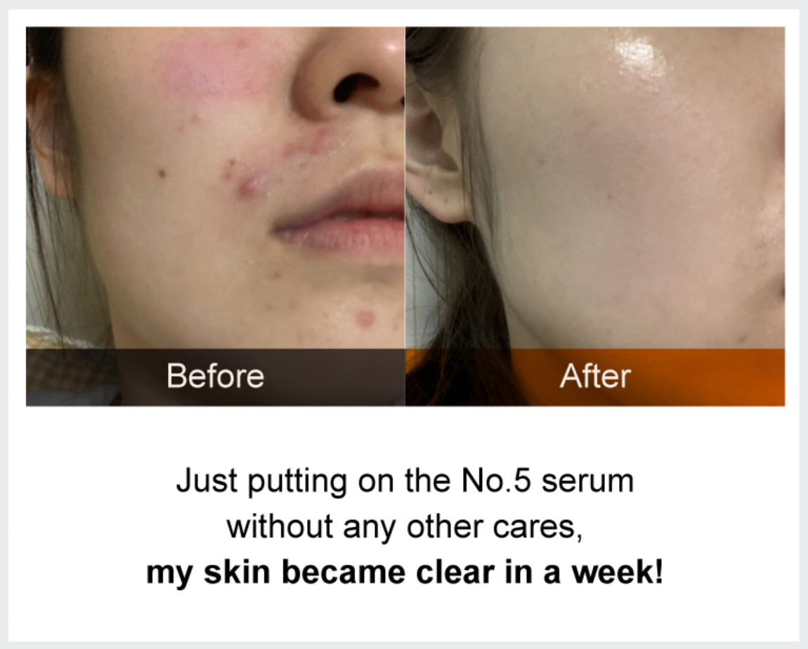 No. 5 Goodbye Blemish Serum 50ml