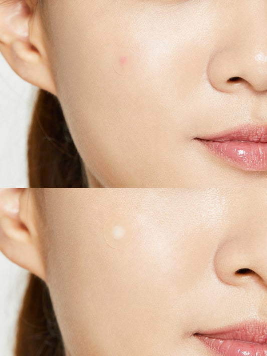 Acne Pimple Master Patch 24pc