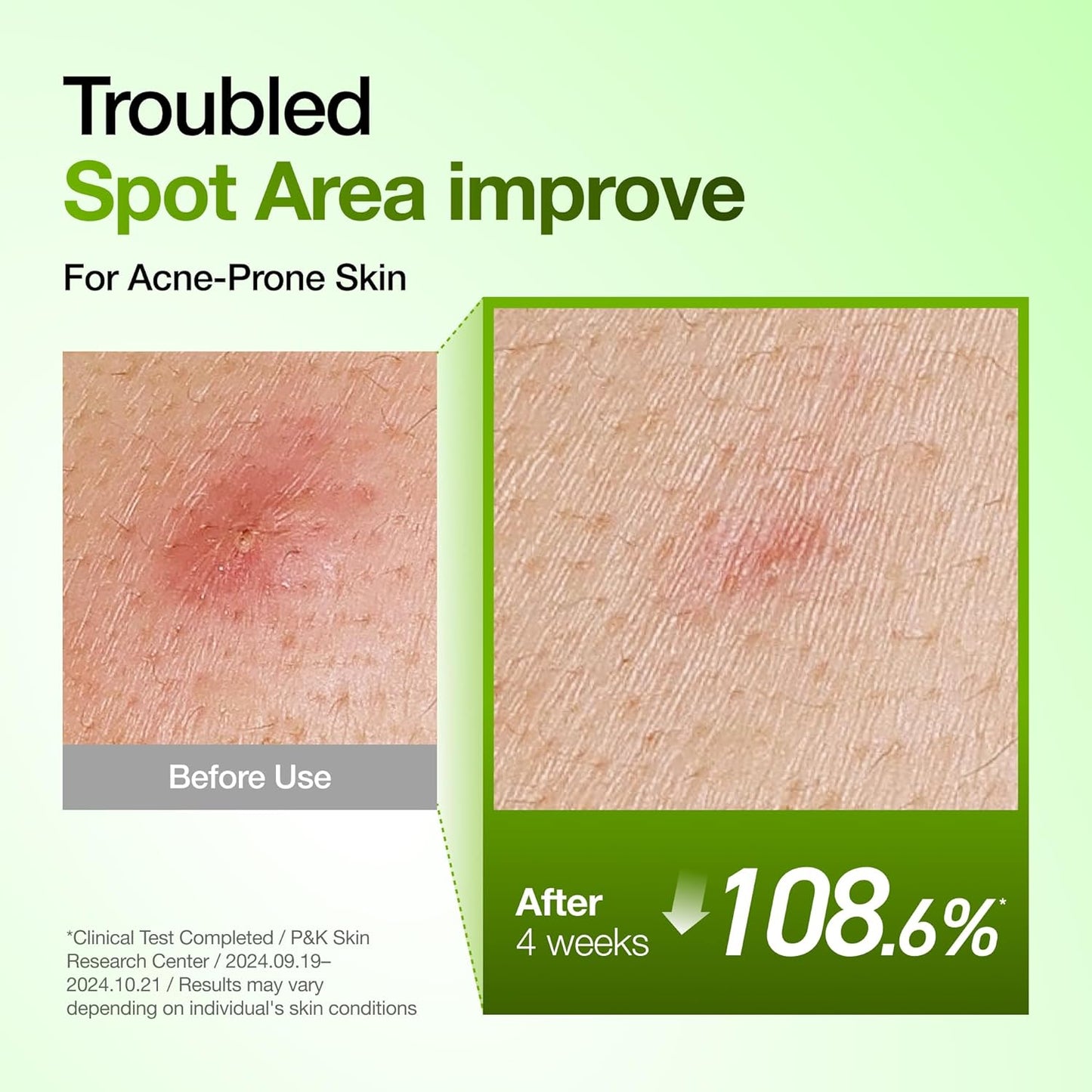 Azelaic Acid 10 Hyaluron Redness Soothing Serum