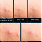 Acne Spot Patch Super Thin (15 patches)
