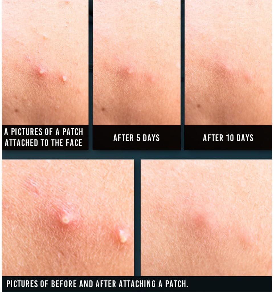 Acne Spot Patch Super Thin (15 patches)